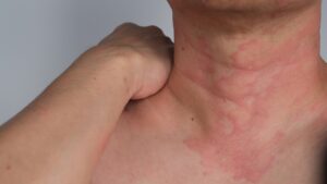 Close,Up,Image,Of,Skin,Texture,Suffering,Severe,Urticaria,Or