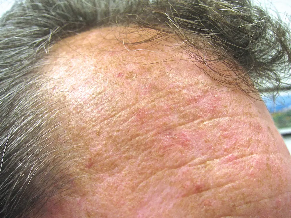 Actinic keratoses