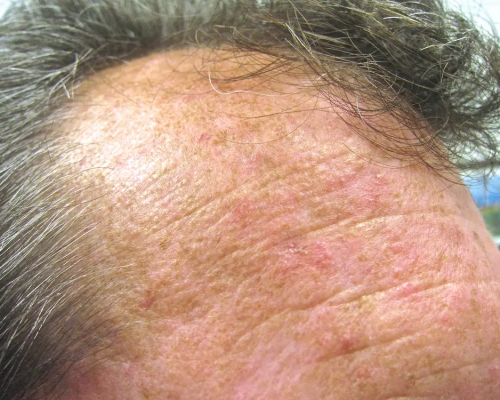 Actinic keratoses Actinic keratoses