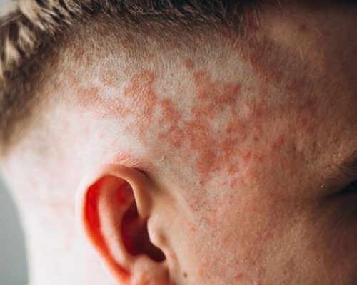 psoriasis genitals 1 psoriasis genitals 1