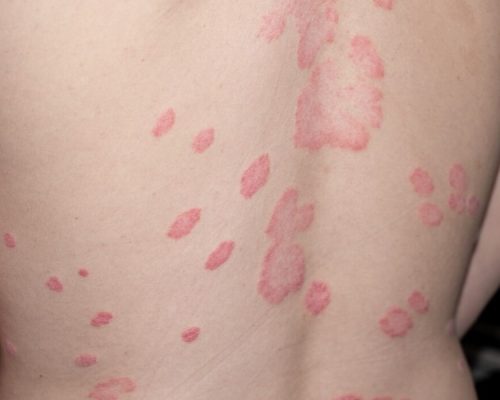 psoriasis