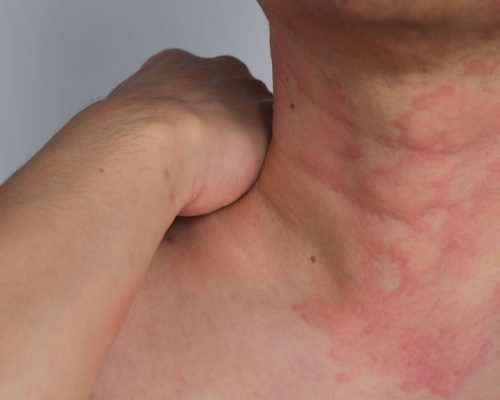 Close,Up,Image,Of,Skin,Texture,Suffering,Severe,Urticaria,Or